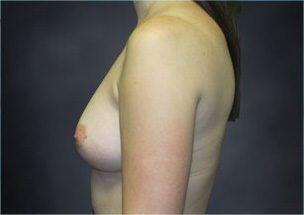 Breast Augmentation Before & After Image