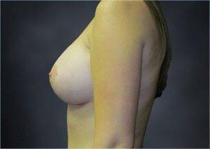 Breast Augmentation Before & After Image