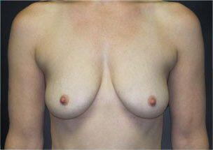 Breast Augmentation Before & After Image