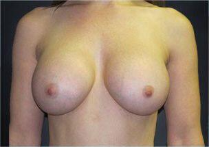 Breast Augmentation Before & After Image