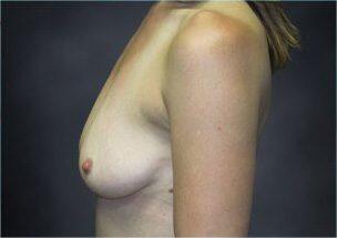 Breast Augmentation Before & After Image