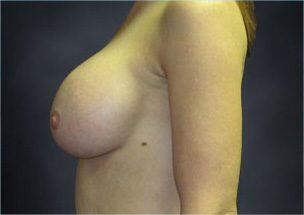 Breast Augmentation Before & After Image