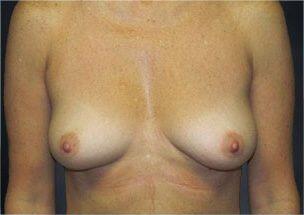 Breast Augmentation Before & After Image