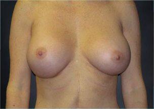 Breast Augmentation Before & After Image