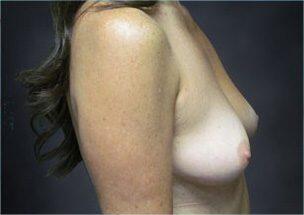 Breast Augmentation Before & After Image