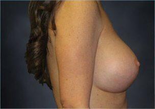 Breast Augmentation Before & After Image