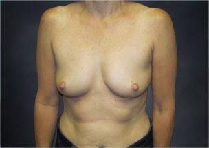 Breast Augmentation Before & After Image