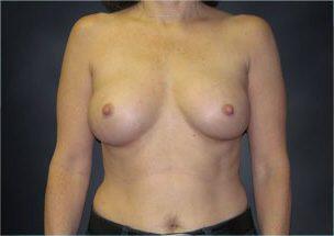 Breast Augmentation Before & After Image