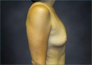 Breast Augmentation Before & After Image