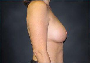 Breast Augmentation Before & After Image