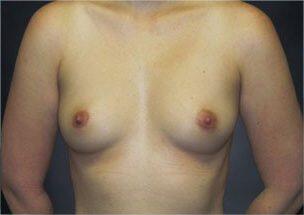 Breast Augmentation Before & After Image