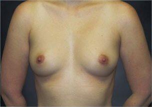 Breast Augmentation Before & After Image