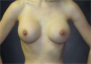 Breast Augmentation Before & After Image