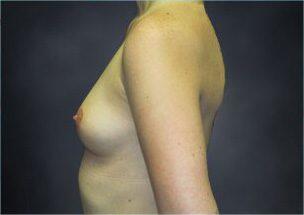 Breast Augmentation Before & After Image