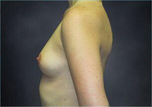 Breast Augmentation Before & After Image