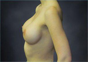 Breast Augmentation Before & After Image