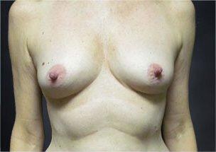 Breast Augmentation Before & After Image