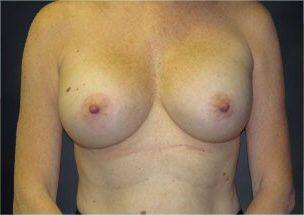 Breast Augmentation Before & After Image