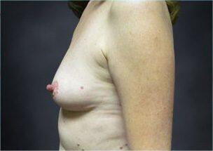 Breast Augmentation Before & After Image