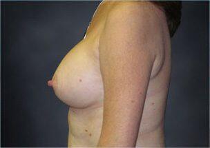 Breast Augmentation Before & After Image