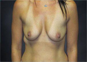 Breast Augmentation Before & After Image