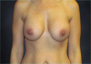 Breast Augmentation Before & After Image