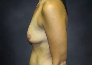 Breast Augmentation Before & After Image