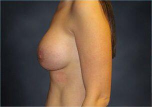 Breast Augmentation Before & After Image