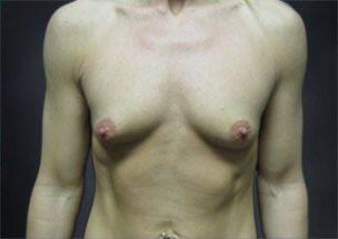 Breast Augmentation Before & After Image