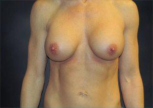 Breast Augmentation Before & After Image