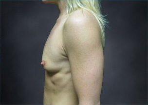 Breast Augmentation Before & After Image