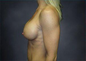 Breast Augmentation Before & After Image