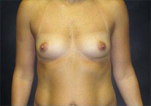 Breast Augmentation Before & After Image