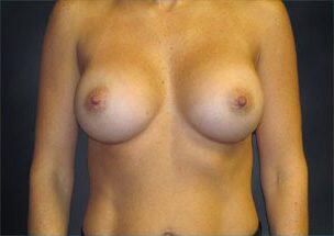 Breast Augmentation Before & After Image