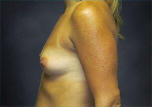 Breast Augmentation Before & After Image