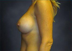 Breast Augmentation Before & After Image