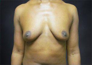 Breast Augmentation Before & After Image