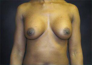 Breast Augmentation Before & After Image