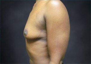 Breast Augmentation Before & After Image