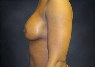 Breast Augmentation Before & After Image