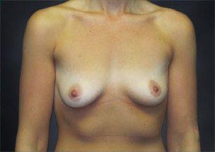 Breast Augmentation Before & After Image