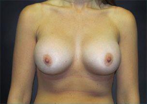 Breast Augmentation Before & After Image