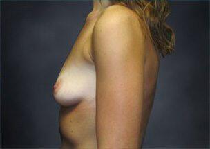 Breast Augmentation Before & After Image