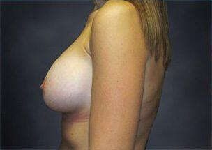 Breast Augmentation Before & After Image