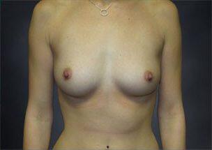 Breast Augmentation Before & After Image