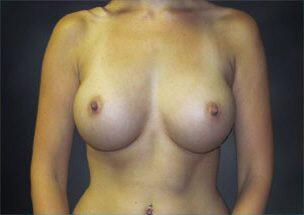 Breast Augmentation Before & After Image