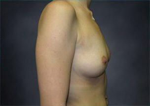 Breast Augmentation Before & After Image