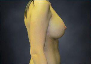 Breast Augmentation Before & After Image