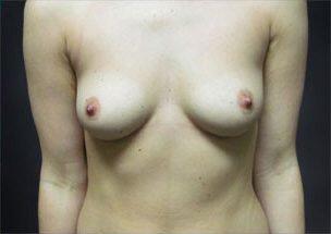 Breast Augmentation Before & After Image