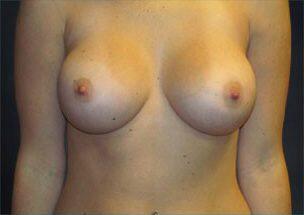 Breast Augmentation Before & After Image